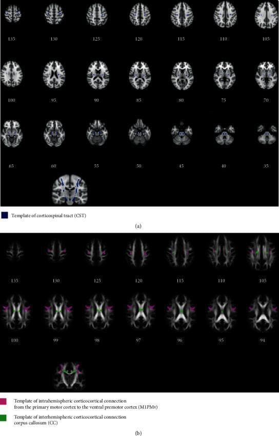 This diagnostic image displays template tracts of the human brain reconstructed via probabilistic tractography, presented across a series of axial neuroimaging slices and coronal views. Part (a) illustrates the Corticospinal Tract (CST) in blue, showing its bilateral longitudinal descent from the primary motor cortex through the posterior limb of the internal capsule and cerebral peduncles, converging toward the ventral medulla oblongata. Part (b) visualizes corticocortical connections: pink regions represent intrahemispheric connections between the primary motor cortex (M1) and the ventral premotor cortex (PMv), while green regions represent interhemispheric connections passing through the corpus callosum (CC). The visualization demonstrates the spatial distribution and anatomical pathways of white matter fibers essential for motor control. These templates, derived from healthy subjects, serve as a clinical reference for evaluating tract integrity and fractional anisotropy (FA) changes in conditions such as stroke. The image is optimized for neuroanatomical education and neuroradiological research involving diffusion-weighted imaging (DWI) and fiber tracking.
