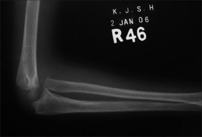 This lateral X-ray radiograph of a pediatric elbow demonstrates a chronic Monteggia fracture-dislocation. The imaging shows a significant anterior dislocation of the radial head, which is no longer aligned with the humeral capitellum. Simultaneously, the proximal ulna exhibits a distinct apex-posterior angulation and cortical irregularity, characteristic of a previous ulnar shaft fracture that has healed in malalignment (malunion). The radiocapitellar line, which normally passes through the center of the capitellum in all views, is clearly disrupted. This diagnostic image is a classic representation used in orthopedic education to illustrate the importance of assessing the entire forearm when an ulnar fracture is present, as well as the long-term sequelae of a missed or untreated Monteggia lesion in a 12-year-old patient. Key educational features include the anatomical relationship between the distal humerus, proximal radius, and ulna, and the structural abnormalities resulting from pediatric forearm trauma.