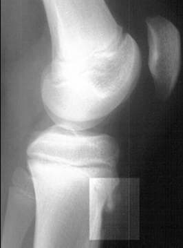 This lateral knee radiograph of a pediatric patient demonstrates the classic radiographic features of Osgood-Schlatter disease. The imaging reveals a prominent tibial tubercle with clear evidence of fragmentation and heterotopic ossification within the patellar tendon insertion site. In addition to the bony changes, there is distinct soft tissue swelling and thickening of the patellar tendon overlying the apophysis. The overall joint alignment is maintained, with normal positioning of the patella relative to the distal femur and a well-preserved tibiofemoral joint space. The growth plates are visible, confirming the adolescent stage of skeletal development. This diagnostic image is used to illustrate traction apophysitis of the tibial tubercle, a common cause of anterior knee pain in active adolescents. The clinical significance of these findings relates to the repetitive strain on the patellar tendon at its insertion point, leading to microtrauma and subsequent fragmentation of the developing bone.