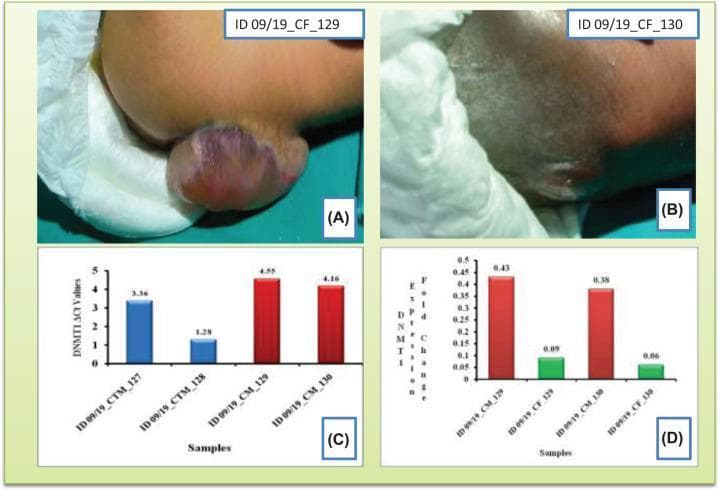 This composite educational image illustrates Neural Tube Defects (NTDs) and related genetic expression data. Panels (A) and (B) are clinical photographs of newborns showing manifestations of spina bifida. Image A demonstrates a cystic spina bifida (myelomeningocele or meningocele) presented as a prominent, spherical, fluid-filled sac protruding from the lumbosacral region, covered by thin, translucent skin with pink and purplish discoloration. Image B shows a different case with a less pronounced protrusion, possibly indicating spina bifida occulta or a smaller closed neural tube defect with associated skin dimpling or scarring. Panels (C) and (D) are quantitative bar charts related to DNMT1 gene expression. Chart C compares ΔCt values between control mothers (CTM) and case mothers (CM), showing higher ΔCt (lower expression) in mothers who gave birth to NTD babies. Chart D shows the fold change (2−ΔΔCt) comparing case mothers to their respective fetuses (CF), illustrating a significant reduction in DNMT1 expression in the affected newborns. This material is designed for medical genetics and pediatrics, demonstrating the phenotypic presentation of NTDs alongside molecular epigenetic findings.