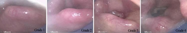 This diagnostic image series displays four endoscopic clinical photographs categorized as SaCoVLM™ glottic exposure grades, illustrating the airway view obtained via a video laryngeal mask airway (LMA). Grade 1 (Far Left): Minimal visualization showing only the lateral aspect of the right aryepiglottic fold and a small portion of the laryngeal inlet. Grade 2 (Middle Left): Improved exposure revealing bilateral aryepiglottic folds and a wider view of the laryngeal inlet. Grade 3 (Middle Right): Advanced exposure where the entire laryngeal inlet and the posterior portion of the glottis become visible; the mucosa appears more textured with visible vasculature. Grade 4 (Far Right): Optimal exposure showing the whole glottis, including the vocal cords and the dark lumen of the trachea. The sequence demonstrates the progressive visibility of laryngeal landmarks from a tangential epiglottic view to a direct axial glottic view. These grades serve as a clinical tool for anesthesiologists to evaluate the positioning and efficacy of visual-guided supraglottic airway devices during airway management and ventilation.