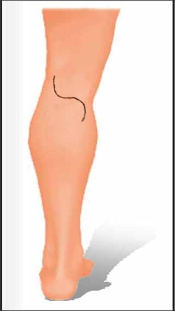This medical illustration depicts the surgical planning for a posterior approach to the knee, specifically for popliteal lymph node dissection. The image shows a posterior view of the left lower limb with a planned S-shaped (Lazy-S) incision line. The central transverse segment of the incision is positioned directly over the popliteal crease. The cranial (superior) portion of the incision curves laterally toward the thigh, while the caudal (inferior) portion curves medially toward the calf. This specific curvilinear geometry is designed to provide optimal exposure of the popliteal fossa contents—including the neurovascular bundle and lymph nodes—while preventing vertical scar contracture across the joint flexion line. The anatomical landmarks shown include the posterior thigh, the popliteal region, and the gastrocnemius muscle bulk of the calf. This type of incision is standard in surgical oncology and vascular surgery to minimize functional impairment of the knee joint postoperatively.