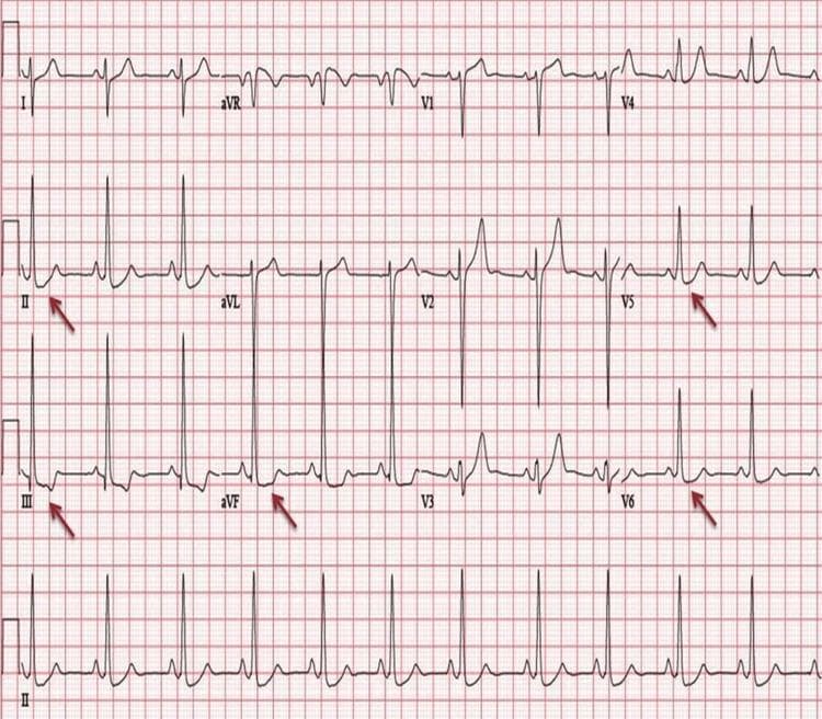 This diagnostic image is a 12-lead electrocardiogram (ECG) demonstrating classic features of Left Ventricular Hypertrophy (LVH) with associated strain patterns. The tracing shows a sinus rhythm with high QRS voltage, characterized by tall R-waves in the lateral leads (V5, V6) and deep S-waves in the right precordial leads (V1, V2), satisfying Sokolow-Lyon criteria for LVH. Red arrows highlight significant ST-segment depression and T-wave inversions in the inferolateral leads (II, III, aVF, V5, and V6). This repolarization abnormality is characteristic of a 'strain pattern' often seen in severe chronic pressure or volume overload of the left ventricle. Clinical relevance includes the assessment of hypertensive heart disease and cardiomyopathies, such as left ventricular non-compaction (LVNC). The ECG serves as a primary screening tool for identifying structural heart changes and associated ischemic or metabolic disturbances.