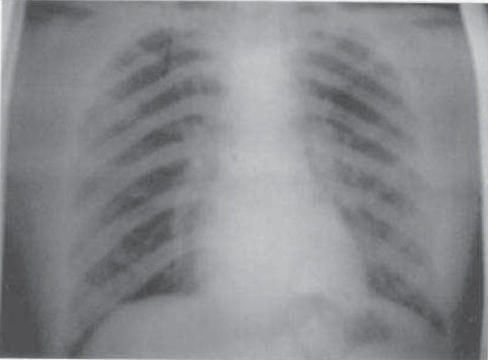 A posterior-anterior (PA) view chest X-ray illustrating normal thoracic anatomy. The radiographic image shows clear and well-aerated bilateral lung fields with no visible pulmonary opacities, infiltrates, or masses. The cardiac silhouette is of normal size and position within the mediastinum, and the trachea is observed at the midline. Both costophrenic angles are sharp, and the diaphragmatic domes are clearly defined and appropriately contoured, indicating the absence of pleural effusion. The skeletal structures, including the ribs and clavicles, appear intact without evidence of acute fracture or deformity. This diagnostic image serves as a baseline for a normal chest examination, illustrating healthy pulmonary vasculature radiating from the hilum toward the lung periphery.
