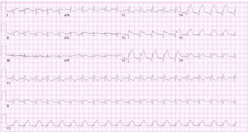 A 12-lead electrocardiogram (ECG) showing signs of an acute anterolateral myocardial infarction in a patient with a baseline right bundle branch block (RBBB). The tracing demonstrates a sinus rhythm with a normal PR interval of approximately 176 ms. Significant findings include ST-segment elevation across the precordial leads V1 through V6, with the most pronounced elevation observed in the lateral leads V4-V6. The QRS complexes in the anterior leads V1-V3 are widened with an RSR' pattern characteristic of RBBB, accompanied by secondary T-wave inversions. Additional ST elevation is noted in leads I and aVL, suggesting lateral wall involvement. The visual findings are consistent with acute transmural ischemia in the distribution of the left anterior descending artery, complicated by significant ventricular dysfunction as indicated by clinical context. This diagnostic image serves as a high-yield educational example of recognizing ST-elevation myocardial infarction (STEMI) in the presence of pre-existing conduction abnormalities.