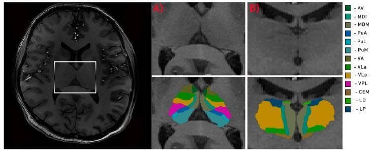 This diagnostic image and anatomical diagram illustrate the detailed segmentation of human thalamic nuclei using high-resolution neuroimaging. The visual includes an axial T1-weighted MRI scout view showing the diencephalon, with a white box highlighting the thalamus. Panels A and B display magnified axial and coronal cross-sections, respectively, with bottom panels featuring color-coded probabilistic segmentation overlays. Key identified nuclei include the anteroventral (AV), mediodorsal (MDI, MDM), pulvinar (PuA, PuL, PuM), ventral anterior (VA), ventral lateral (VLa, VLp), ventral posterolateral (VPL), central medial (CEM), laterodorsal (LD), and lateral posterior (LP) regions. The segmentation demonstrates the spatial organization of the thalamus, such as the posterior positioning of the pulvinar nuclei and the lateral arrangement of the ventral posterior complex. This material serves as an educational resource for neuroanatomy, neuroradiology, and computational neuroscience, specifically regarding the localization of specific thalamic functional zones in clinical research such as 7T MRI volumetric studies.