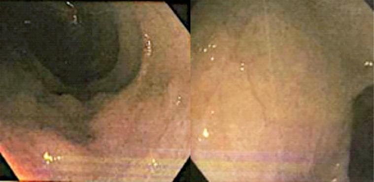 This diagnostic image consists of two endoscope frames from a colonoscopy, depicting the rectum and sigmoid colon of a patient with Ulcerative Colitis. The visual highlights active chronic colitis characterized by diffuse mucosal inflammation. Key features include multiple irregular ulcers appearing as dark, depressed lesions against a background of erythematous (reddened) and edematous mucosa. The ulcerations vary in morphology, ranging from small pinpoint erosions to larger, more confluent serpiginous patterns. There is a noticeable loss of the normal fine vascular pattern, indicative of significant mucosal engorgement and friability. These findings are clinically relevant for assessing disease activity and severity in Inflammatory Bowel Disease (IBD), specifically correlating with high Pediatric Ulcerative Colitis Activity Index (PUCAI) scores in pediatric gastroenterology.