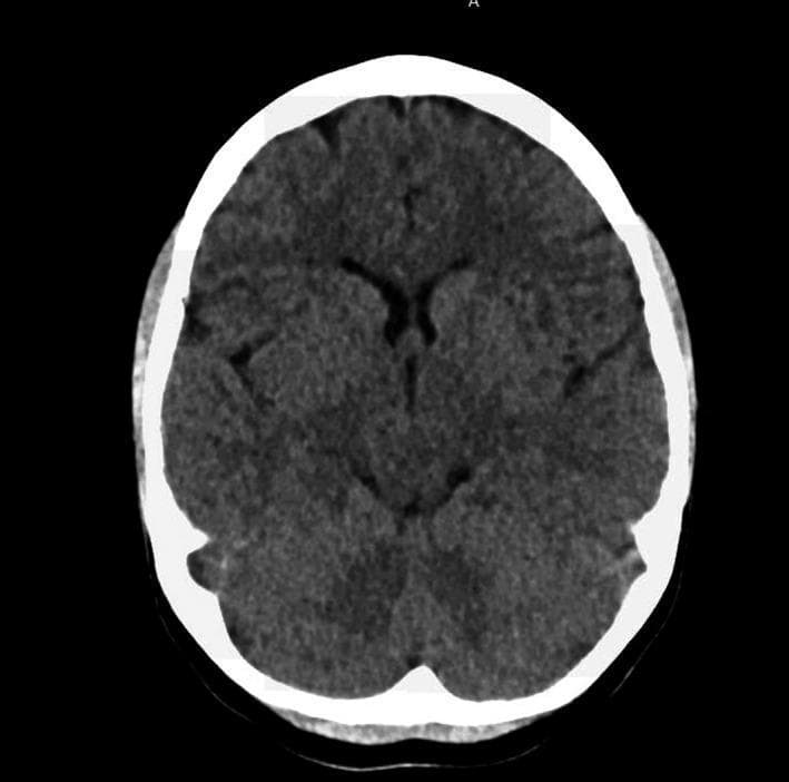 This diagnostic image is a non-contrast Computed Tomography (CT) scan of the head in an axial plane. The scan demonstrates the intracranial anatomy at the level of the basal ganglia and lateral ventricles. The brain parenchyma shows normal, homogeneous attenuation without evidence of acute intracranial hemorrhage, midline shift, or mass effect. Key anatomical structures visible include the frontal and occipital lobes, the Sylvian fissures, and the anterior horns of the lateral ventricles, which appear as hypodense (dark), fluid-filled spaces. The skull is depicted as a hyperdense (bright white) peripheral ring, indicating normal calcification of the cranial vault. This image is representative of a routine screening for neurological symptoms, such as suspected subarachnoid hemorrhage, where the initial radiological finding is unremarkable. The scan is clinically significant for students and practitioners to understand the baseline appearance of a 'normal' head CT in an emergency or diagnostic triage context.