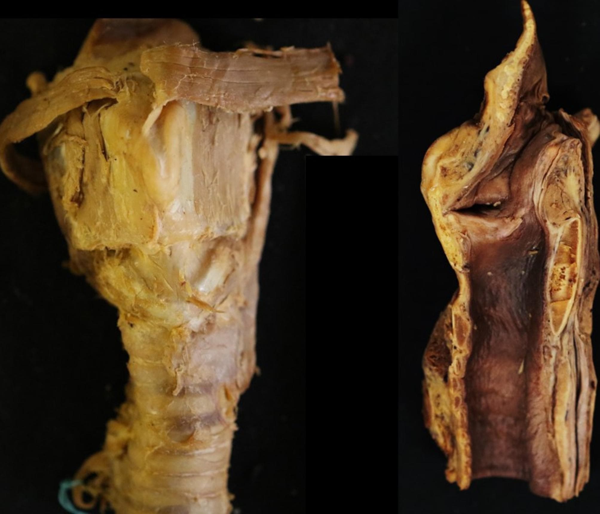 This composite clinical photograph displays a dissected human larynx, providing a detailed anatomical study of the perilaryngeal structures. The left panel shows a frontal (anterior) view of the larynx and upper trachea. Key visible structures include the thyroid cartilage, cricoid cartilage, and the intervening cricothyroid ligament. Striated muscle fibers and connective tissues are seen superiorly near the hyoid region, while the trachea is identifiable inferiorly by its characteristic horizontal cartilaginous rings. The right panel presents a midsagittal section, exposing the internal laryngeal cavity. This view highlights the contrast between the external yellowish connective tissues and the darker, brownish mucosal lining of the airway. Anatomical landmarks such as the epiglottis, laryngeal vestibule, and the posterior plate of the cricoid cartilage are visible in cross-section. These images are typically used in surgical anatomy or otolaryngology to study the morphometry of the cricothyroid ligament and laryngeal dimensions for procedures like cricothyrotomy or endotracheal intubation training.