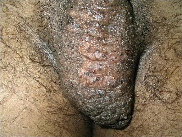 This clinical photograph shows a close-up view of a male scrotum on the first postoperative day following radiofrequency current coagulation for lymphangioma circumscriptum. The scrotal skin is hyperpigmented (consistent with Fitzpatrick skin type V) and displays an irregular, cobblestone texture. Multiple grouped vesicles are distributed across the surface, particularly concentrated on the left side. Some vesicles appear whitish and translucent, containing clear lymphatic fluid, while others are dark-red to blackish, indicating the presence of blood-tinged fluid or hemorrhagic crusting. The overall appearance is characteristic of superficial lymphangioma (lymphangioma circumscriptum), which often presents as persistent clusters of small, fluid-filled vesicles described as 'frog spawn.' Areas of hyperpigmented skin and slight erythema around the lesions are consistent with early postoperative changes and chronic skin irritation from lymphorrhoea.
