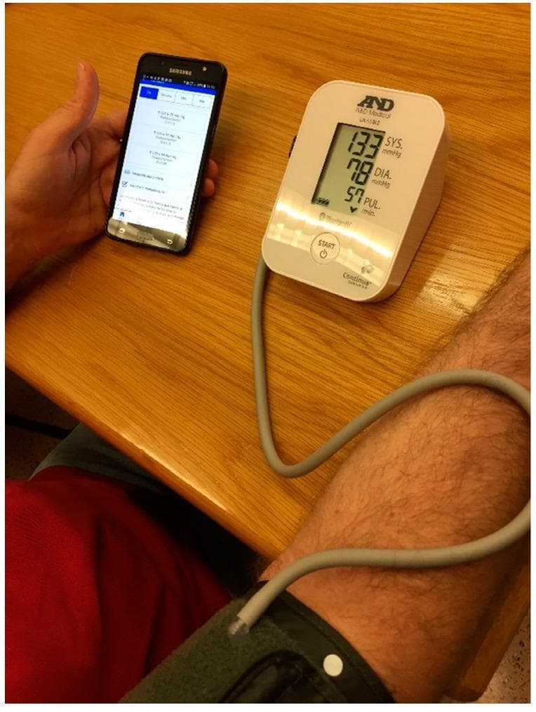 This clinical photograph illustrates a patient-centered remote health monitoring setup for managing hypertension. The central focus is a digital oscillometric blood pressure monitor (A&D Medical UC-651BLE) displaying a systolic pressure of 133 mmHg, a diastolic pressure of 78 mmHg, and a pulse rate of 57 bpm. The device features a Bluetooth connectivity symbol, indicating its role in a wireless telemedicine ecosystem. A gray inflatable cuff is correctly placed on the patient's arm and connected to the base unit via tubing. In the adjacent hand, a smartphone displays a specialized medical application with a history of physiological readings, demonstrating the integration of mobile health (mHealth) technology in chronic disease management. This visual serves to teach the application of 'smart' diagnostic tools in home-based clinical processes, emphasizing data acquisition and real-time patient empowerment through digital tracking.