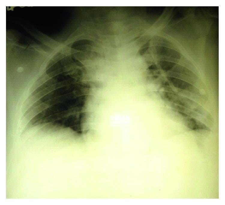 This diagnostic image is a posterior-anterior (PA) chest X-ray demonstrating significant pulmonary pathology. The radiograph shows bilateral, patchy alveolar opacities distributed throughout the upper, middle, and lower zones of both lungs. These opacities exhibit a predominantly peripheral distribution, which is a classic radiographic feature often associated with non-cardiogenic pulmonary edema or acute respiratory distress syndrome (ARDS). Additionally, there is evidence of bilateral blunting of the costophrenic angles, consistent with small bilateral pleural effusions. The cardiac silhouette appears within normal limits for size, further supporting a non-cardiac etiology for the observed pulmonary edema. This clinical presentation is often seen in severe systemic infections like leptospirosis (Weil's disease) or other inflammatory conditions leading to increased capillary permeability. Educational concepts include differentiating cardiogenic from non-cardiogenic edema based on heart size and opacity distribution.