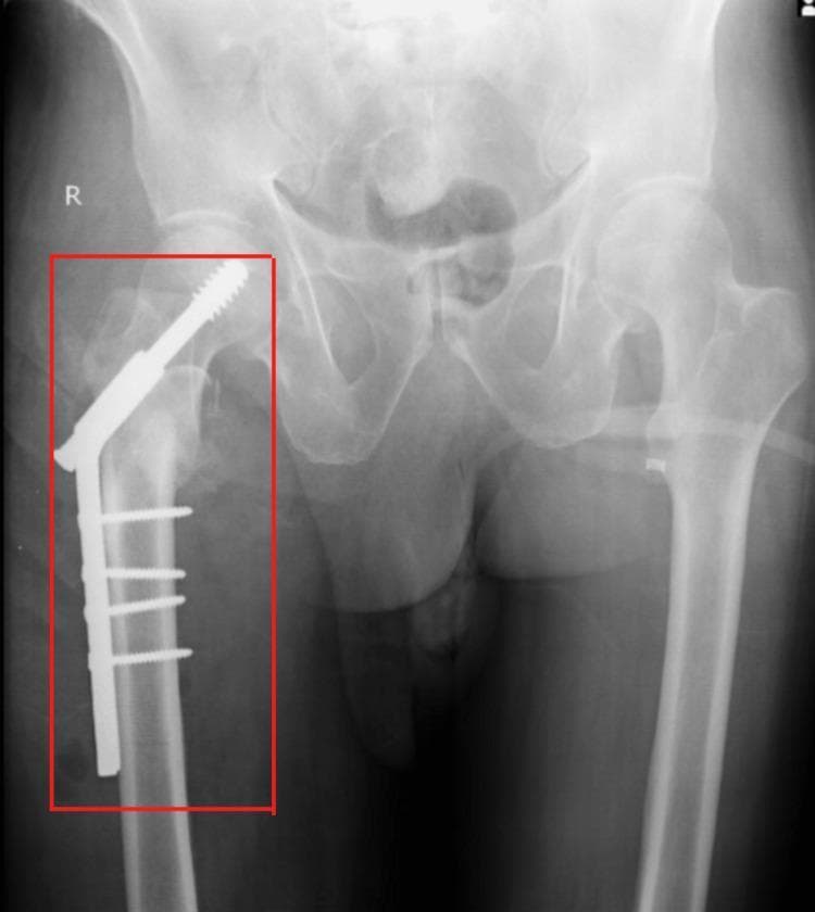 An anteroposterior (AP) X-ray of the pelvis and bilateral hips showing internal fixation of a right proximal femur fracture. The image captures the pelvic girdle, sacroiliac joints, and proximal femurs. On the right side, a Dynamic Hip Screw (DHS) system is visible, consisting of a large-diameter lag screw traversing the femoral neck into the femoral head, coupled with a lateral side plate. The plate is secured to the femoral shaft with four cortical screws. This hardware illustrates the post-operative management of an intertrochanteric hip fracture. The contralateral left hip appears anatomically normal without hardware. An 'R' marker denotes the right anatomical side. The imaging serves as a clinical example of Open Reduction Internal Fixation (ORIF) and is used to evaluate hardware positioning, fracture alignment, and subsequent healing.