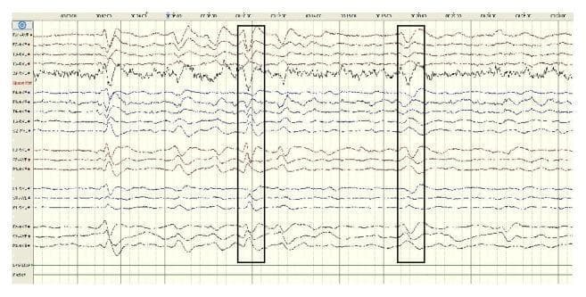 This diagnostic image shows a multi-channel electroencephalogram (EEG) recording demonstrating triphasic wave patterns, a hallmark of metabolic encephalopathy (such as hepatic or uremic encephalopathy). The recording displays multiple traces representing different anatomical brain regions. The highlighted waveforms exhibit a classic triphasic morphology: an initial sharp negative deflection, followed by a prominent, wider positive deflection, and concluding with a second negative deflection. These waves appear synchronously and periodically with a frequency of approximately 1.5–2 Hz and amplitudes typically exceeding 70 μV. Spatially, the triphasic waves are distributed diffusely across both hemispheres but show a characteristic anterior-to-posterior time lag and greater prominence in the frontal leads. The background activity is slowed, consistent with generalized cerebral dysfunction. This visual serves as a primary educational example for identifying EEG biomarkers of systemic metabolic derangement affecting the central nervous system.