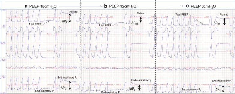 This diagnostic comparison chart displays mechanical ventilation waveforms during a PEEP (positive end-expiratory pressure) titration procedure for a patient with acute respiratory distress syndrome (ARDS). The graphic is divided into three panels representing PEEP levels of 18 cmH2O (a), 12 cmH2O (b), and 6 cmH2O (c). Each panel displays synchronized tracings for Airway Pressure (Pao), Flow, Volume, Esophageal Pressure (Pes), and Transpulmonary Pressure (PL). Key physiological markers identified include Total PEEP, Plateau Pressure, Respiratory System Driving Pressure (ΔPRS), End-expiratory PL, End-inspiratory PL, and Transpulmonary Driving Pressure (ΔPL). The waveforms illustrate the optimization of lung mechanics at 12 cmH2O, where ΔPRS and ΔPL are minimized, and end-expiratory transpulmonary pressure is near zero. Panel (a) shows signs of overdistension with high driving pressures, while panel (c) demonstrates derecruitment as evidenced by a negative end-expiratory PL and increased driving pressures. This visualization highlights the clinical utility of esophageal manometry in tailoring PEEP to manage lung stress and compliance in complex respiratory cases.