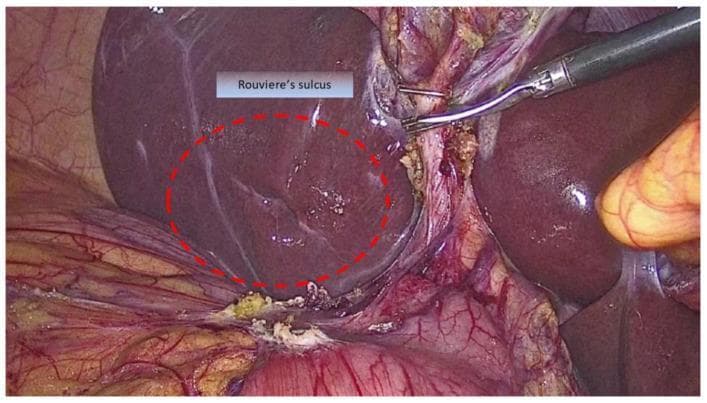 This clinical photograph provides an intraoperative view during a laparoscopic cholecystectomy, focusing on the identification of Rouviere's sulcus (RS). The sulcus is circumscribed by a red dotted line and appears as a horizontal-to-oblique groove approximately 2–5 cm in length on the visceral surface of the liver, specifically in the right lobe lateral to the hepatic hilum. The image demonstrates the anatomical landmark's importance in establishing a 'safe zone' for dissection to avoid bile duct injury. Visible components include the smooth, dark reddish-brown liver parenchyma, surgical grasping instruments retracting the gallbladder neck, and the hepatoduodenal ligament containing critical vascular and biliary structures. The RS serves as a key external landmark indicating the plane of the common bile duct, where dissection superior to this horizontal plane is considered safe. This visual is intended for surgical education regarding the R4U line concept and safe laparoscopic techniques.