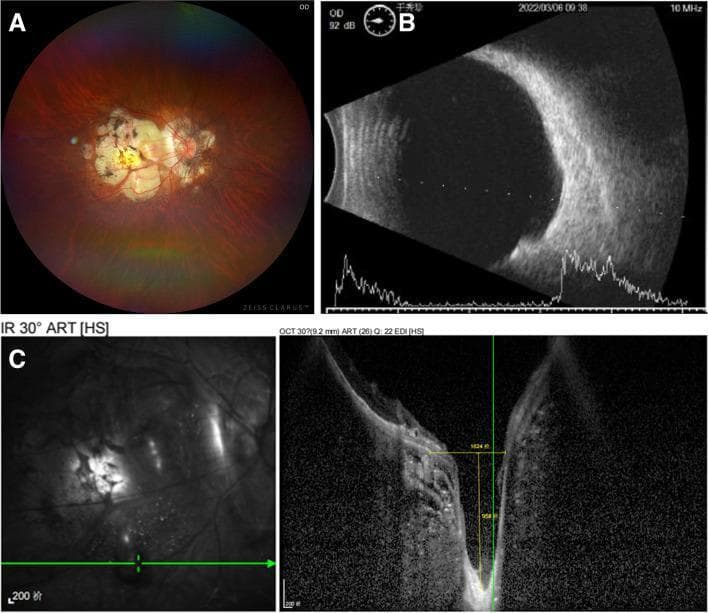 This composite diagnostic image illustrates pathological myopia in a 57-year-old patient. Panel A is a fundus photograph showing severe myopic retinal degeneration and chorioretinal atrophy at the posterior pole, exposing the underlying white sclera. A distinct grayish oval depression (macular scleral pit) is visible inferior to the macula. Panel B displays B-scan ultrasonography (top) and A-scan (bottom), revealing a significant posterior staphyloma characterized by an abnormal elongation and posterior bulging of the ocular wall. Panel C presents an Enhanced Depth Imaging Optical Coherence Tomography (EDI-OCT) cross-section, demonstrating a deep, crater-like pit measuring approximately 958 μm in depth. The OCT scan highlights extreme thinning of the neurosensory retina and partial loss of the retinal pigment epithelium and choroid within the pit area. These findings collectively demonstrate a macular scleral pit (MSP) associated with high axial myopia and posterior staphyloma.