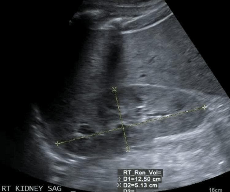 A diagnostic B-mode ultrasound image of the right kidney in a sagittal (longitudinal) plane. The renal parenchyma exhibits diffuse increased echogenicity, appearing hyperechoic relative to the adjacent liver tissue (noted at the top of the field). This loss of normal corticomedullary differentiation and increased brightness are characteristic findings in medical renal disease, such as chronic kidney disease or acute glomerulonephritis. The image includes linear calipers measuring the renal length (D1 = 12.50 cm) and width (D2 = 5.13 cm). Key visible structures include the hyperechoic central renal sinus, the surrounding thickened or hyperechoic renal cortex, and the distinct outer renal capsule. No evidence of hydronephrosis (dilation of the collecting system) is observed. This visual is typical for educational training in nephrology and radiology to identify markers of intrinsic renal parenchymal pathology.