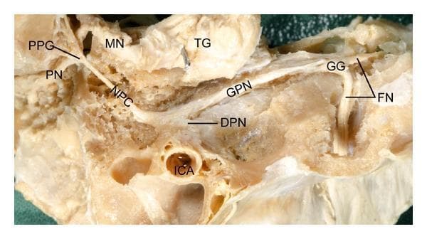A clinical photograph of a high-resolution cadaveric dissection illustrating the complex neural connections between the geniculate ganglion (GG) and the pterygopalatine ganglion (PPG). The anatomical specimen displays the facial nerve (FN) emerging from the internal acoustic meatus and transitioning at the geniculate ganglion. From the GG, the greater petrosal nerve (GPN) is seen coursing anteriorly to join the deep petrosal nerve (DPN), which emerges near the internal carotid artery (ICA). These nerves merge to form the nerve of the pterygoid canal (NPC), also known as the Vidian nerve, which terminates in the pterygopalatine ganglion (PPG). The PPG is shown as a central hub giving rise to the palatine nerves (PN). Superior to this pathway, the trigeminal ganglion (TG) and the maxillary nerve (MN) are clearly visible, demonstrating their spatial relationship to the autonomic fibers. This educational dissection serves as a vital reference for understanding the parasympathetic and sympathetic pathways of the head, relevant for otolaryngology and neurosurgery.