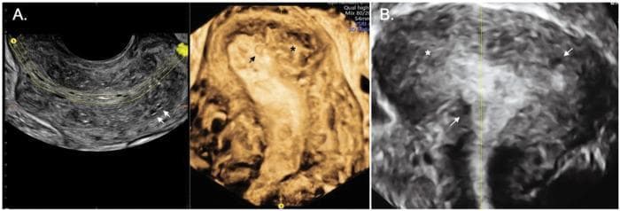This diagnostic image set showcases 2D and 3D transvaginal ultrasound (TVUS) findings of diffuse adenomyosis in a human uterus. Panel A displays a heterogeneous myometrium with an irregular and interrupted junctional zone (JZ). Key markers include small, anechoic myometrial cysts (indicated by arrows), which represent ectopic endometrial glands. The 3D reconstruction in the center emphasizes the structural distortion of the uterine cavity. Panel B demonstrates severe diffuse adenomyosis, characterized by a globular, enlarged, and asymmetrical uterus. The image reveals an ill-defined, thickened JZ and extensive infiltration of the myometrium, highlighted by further myometrial cysts and echogenic islands (indicated by asterisks and arrows). These sonographic features are classic indicators for the Morphological Uterus Sonographic Assessment (MUSA) criteria used to diagnose adenomyosis and differentiate it from leiomyomas. The content is suitable for gynecological and radiological education at an intermediate to advanced level, focusing on identifying uterine pathologies through imaging modalities.