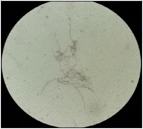 This diagnostic image shows a direct microscopic examination of a clinical specimen using a potassium hydroxide (KOH) mount. The field of view displays clear, translucent fungal elements against a light, granular background characteristic of digested host tissue. The primary features include long, slender, septate hyphae that exhibit regular cross-walls and occasional branching. Associated with these hyphal structures are chains of conidia (spores) in an acropetal arrangement, suggesting fungal proliferation. The morphology is consistent with a phaeohyphomycotic or related filamentous fungal infection, particularly Cladophialophora species in the context of a cerebral abscess. This visual aid is intended for medical education in microbiology and infectious diseases to demonstrate the rapid identification of fungal morphology in clinical exudates. The absence of bacterial structures and the presence of septate hyphae with conidial chains provide a definitive visual diagnostic path for beginning antifungal therapy before culture confirmation.