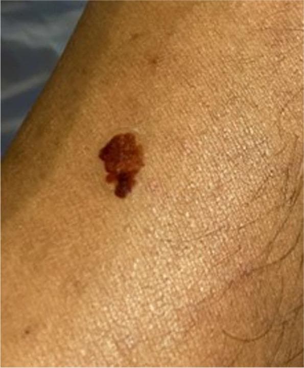 This clinical photograph shows a close-up view of a pigmented skin lesion, specifically a medical moulage representing a malignant melanoma in the form of a high-resolution transfer tattoo. The lesion exhibits the classic 'ABCDE' criteria for melanoma: it is highly asymmetric (Asymmetry), possesses irregular, ill-defined, and notched borders (Border), and displays significant color variegation (Color) with shades ranging from dark brown to tan and deep black-red. The surface appears textured and slightly elevated above the surrounding healthy skin. The image is used as an educational tool for medical training and Objective Structured Clinical Examinations (OSCEs) to teach students and healthcare professionals how to identify suspicious skin morphology on various skin tones. The surrounding skin appears healthy with no visible signs of acute inflammation, such as edema or surrounding erythema.