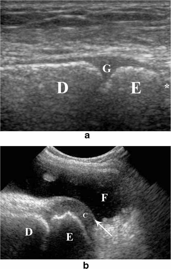 This dual-panel figure provides a musculoskeletal ultrasound comparison of the developing bone in pediatric patients. Image (a) is a longitudinal sonographic view of the distal tibia, illustrating the distal growth plate (G) as a characteristic hypo-echoic area located between the echogenic diaphysis (D) and epiphysis (E). The joint space (*) is visible distal to the epiphysis, demonstrating the importance of differentiating the physis from the intra-articular space. Image (b) presents a longitudinal view of the knee joint in a 5-year-old child. It shows the distal femoral epiphysis (E) and its surrounding peripheral non-ossified cartilage (c). A significant joint effusion (F), seen as an anechoic fluid collection, provides an acoustic window that enhances the visualization of the articular cartilage, which appears as a superficial echogenic line (indicated by an arrow). These images serve as educational references for identifying normal pediatric anatomy and pathological fluid during ultrasound-guided joint procedures.