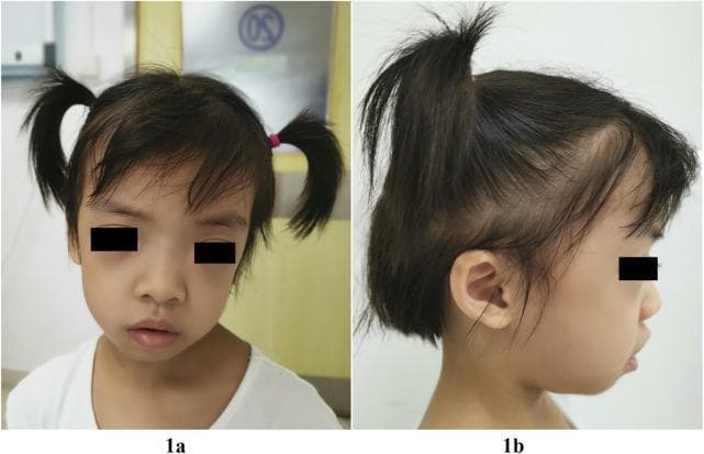 Clinical photograph of a 5-year-old child presenting with dysmorphic facial features characteristic of Noonan syndrome-like disorder with loose anagen hair (NSLAH) associated with a SHOC2 variant. Panel 1a (frontal view) demonstrates macrocephaly, a broad square forehead with frontal bossing, hypertelorism, and downslanting palpebral fissures. A unilateral left-sided ptosis and long eyelashes are also visible. Panel 1b (lateral view) illustrates low-set, posteriorly angulated ears with overfolded pinnae. Both views highlight hair anomalies, specifically sparse, thin, and slow-growing scalp hair with a high frontal hairline. The educational focus is on the recognition of the phenotypic manifestations of RASopathies, aiding in the clinical differentiation of syndromic macrocephaly and ectodermal dysplasia-like features.