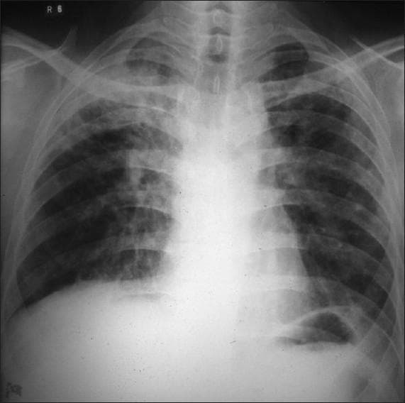 This diagnostic image is a posteroanterior (PA) chest X-ray demonstrating significant pulmonary pathology. The primary finding is located in the right upper lobe, where there are dense, heterogeneous exudative opacities consistent with lung consolidation. Within this region of increased density, a prominent, thick-walled radiolucent cavity is visible, indicating tissue necrosis or cavitation. The distribution of these findings is highly suggestive of secondary (reactivation) pulmonary tuberculosis. In contrast, the left lung field appears relatively clear, although subtle interstitial markings may be present. Key anatomical landmarks including the trachea, clavicles, and cardiac silhouette are visible, with the trachea appearing midline. This image serves as a classic educational example of cavitary lung disease and apical inflammatory processes, emphasizing the radiographic presentation of Mycobacterium tuberculosis infection in an adult patient.