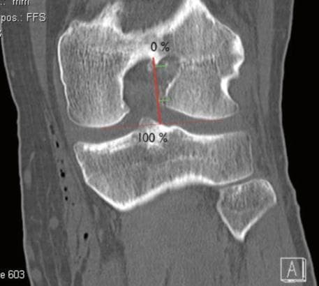 This diagnostic image is a coronal CT reconstruction of the human knee joint, specifically the distal femur and proximal tibia/fibula. The image illustrates a radiological assessment of femoral tunnel positioning following Anterior Cruciate Ligament (ACL) reconstruction, utilizing the method described by Hoser et al. (2005). Visible landmarks include the medial and lateral femoral condyles, the intercondylar notch, and the tibial plateau. A clear surgical femoral tunnel appears as a dark, circular lucency within the lateral femoral condyle near the notch roof. Superimposed red reference lines facilitate measurement: one horizontal line tangent to the most distal points of the femoral condyles and a perpendicular vertical line extending from the intracondylar roof to the distal condylar line. This vertical line is labeled with '0%' at the roof and '100%' at the distal level, serving as a coordinate system to quantify the tunnel's proximal-distal position. This clinical imaging is used in orthopedics to evaluate surgical accuracy and graft placement stability.