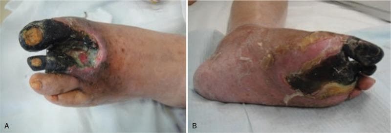 Clinical photographs (A and B) showing a severe diabetic foot ulcer with extensive necrosis and vascular occlusion in the left lower extremity. Image A (dorsal view) reveals significant tissue destruction of the first and second toes, characterized by dry gangrene (blackened, desiccated appearance) and a deep ulceration exposing underlying subcutaneous structures. The wound base contains yellow-green purulent exudate, suggesting secondary infection. Image B (plantar view) demonstrates a large, approximately 9cm x 5cm wound with a central area of black necrotic eschar and slough, involving two-thirds of the plantar surface. There is circumferential erythema (redness) and significant edema (swelling) extending from the wound margins toward the ankle. These clinical features illustrate Wagner Grade 4 diabetic foot complication, indicating critical limb ischemia and a high risk of amputation. Key educational concepts include the recognition of wet and dry gangrene, management of infected diabetic ulcers, and the visual assessment of peripheral arterial disease in chronic diabetic patients.