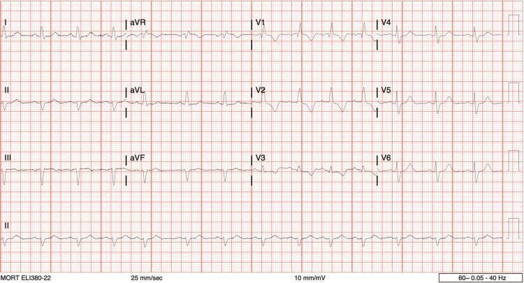 A standard 12-lead electrocardiogram (ECG) printed on red grid paper at 25 mm/sec. The tracing shows a normal sinus rhythm with a regular rate. Key conduction abnormalities are evident: a Right Bundle Branch Block (RBBB) is demonstrated by widened QRS complexes with a classic rSR' pattern and T-wave inversion in the right precordial leads (V1-V3), along with slurred S waves in leads I and V6. There is an associated Left Axis Deviation (LAD), suggested by the predominantly negative QRS complexes in leads II, III, and aVF, which may indicate a concomitant left anterior fascicular block (bifascicular block pattern). There is no significant ST-segment elevation (no STEMI), although minor non-specific ST-segment depression is visible in the inferior leads. The QT interval appears within normal limits. This ECG is representative of common conduction system disease used in cardiology education to identify fascicular and bundle branch blocks.
