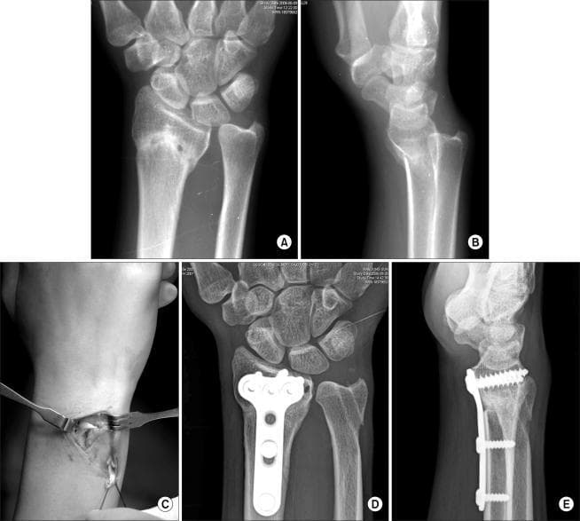 A multi-panel medical image sequence illustrating the management of distal radioulnar joint (DRUJ) instability. Subfigures A and B are preoperative anteroposterior and lateral X-rays of the wrist showing malunion of a distal radius fracture and associated DRUJ subluxation. Subfigure C is an intraoperative clinical photograph showing a palmaris longus tendon graft being used for ligament reconstruction. Subfigures D and E are postoperative anteroposterior and lateral radiographs showing surgical correction. These images demonstrate internal fixation with a volar locking plate and screws on the distal radius following a corrective osteotomy. Restored anatomical alignment of the radius and ulnar head is visible. Key diagnostic features include the presence of radiolucent bone tunnels in the distal radius and ulnar head, indicating the pathways for the ligament reconstruction. The image provides educational value for orthopedic surgery, specifically in treating distal radius malunion and chronic DRUJ instability through combined bony and soft tissue reconstruction.