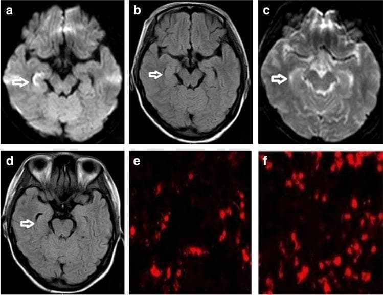 This composite image illustrates diagnostic findings for anti-NMDAR encephalitis, organized into brain MRI scans and indirect immunofluorescence microscopy. Panels (a-d) present axial brain MRI sequences. Panels (a) and (b) show Diffusion-Weighted Imaging (DWI) and Fluid-Attenuated Inversion Recovery (FLAIR) sequences, respectively, at initial presentation, highlighting hyperintense signals in the right hippocampus (marked by white arrows). Panels (c) and (d) demonstrate a follow-up MRI showing the resolution or decrease of these hyperintensities in the same anatomical region. Panels (e) and (f) display immunofluorescence assays for anti-NMDAR antibody titers. Panel (e) depicts a titer of 1:32, showing scattered red fluorescent signals against a dark background. Panel (f) shows a higher antibody titer of 1:320, characterized by a significantly increased density and clustering of red fluorescent signals. These visuals provide a clinical comparison between neuroimaging markers of limbic involvement and laboratory-confirmed antibody concentrations in autoimmune encephalitis.