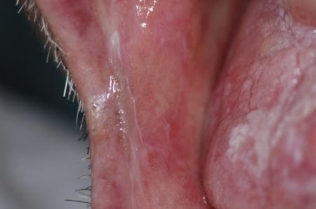 This clinical photograph shows an intraoral view of the right buccal mucosa, demonstrating classic signs of reticular oral lichen planus. The primary visual finding is a network of interlacing white, keratotic lines known as Wickham striae. These thin, lace-like striae form a reticulated pattern over an erythematous and slightly irregular mucosal background. The texture appears somewhat roughened in the areas of keratosis. The distribution of these white markings is localized to the posterior and middle regions of the buccal mucosa. Clinically, this visual presentation is highly characteristic of lichen planus, a chronic inflammatory condition. The image serves as a high-quality educational example for dermatology and oral medicine, illustrating the classic reticular morphology used to distinguish this condition from other oral white lesions such as leukoplakia or candidiasis.