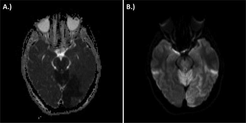 Two axial MRI sequences of the brain demonstrating an acute ischemic stroke within the posterior circulation territory. Figure A shows an Apparent Diffusion Coefficient (ADC) map, while Figure B displays Diffusion-Weighted Imaging (DWI). In the ADC map (A), there are regions of low signal intensity (dark) in the left occipital lobe, signifying restricted water diffusion. Correspondingly, the DWI sequence (B) reveals hyperintense (bright) signals in the same left occipital region, as well as extensive involvement of the cerebellum and brainstem (pons and medulla). This contrast mismatch—hypointensity on ADC and hyperintensity on DWI—is the hallmark of acute cytotoxic edema and infarction. The anatomical distribution follows the posterior circulation, consistent with vascular occlusion affecting the vertebrobasilar system and posterior cerebral arteries. This visual illustrates the diagnostic utility of diffusion restriction in identifying acute cerebral ischemia shortly after an event.
