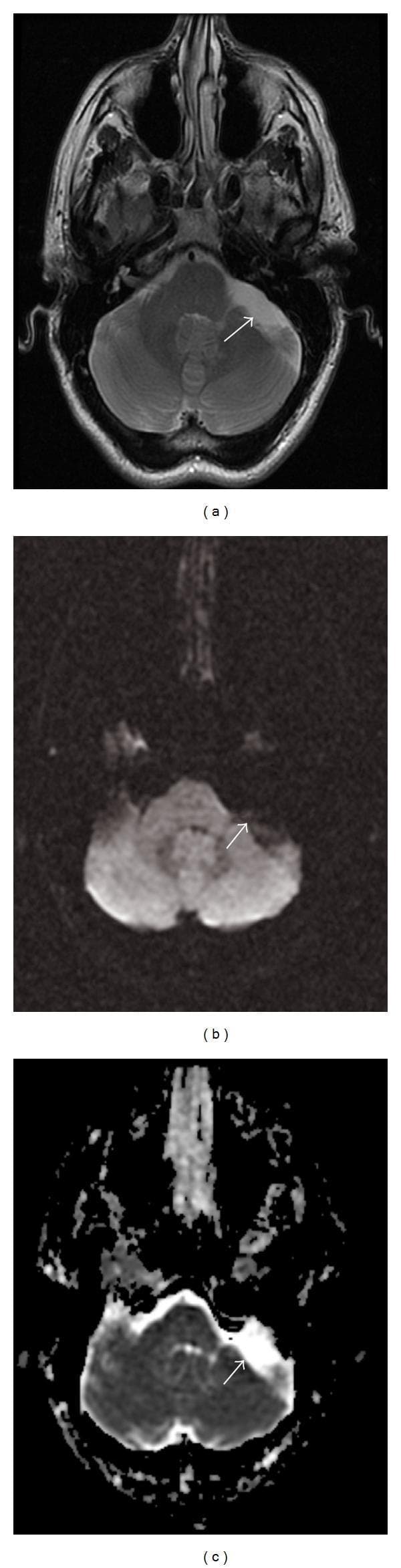 Diagnostic neuroradiology images showing a cerebellopontine angle (CPA) arachnoid cyst in a 32-year-old male. The composite includes three axial MRI sequences at the level of the posterior fossa: (a) Fast Spin Echo T2-weighted image demonstrating a well-circumscribed, homogeneous hyperintense mass in the left CPA, exerting mild mass effect on the adjacent cerebellum and pons; (b) Diffusion-Weighted Imaging (DWI) sequence showing the lesion as hypointense (dark); and (c) Apparent Diffusion Coefficient (ADC) map showing the lesion as hyperintense (bright). This combination of signal characteristics—specifically high T2 signal with facilitated diffusion (dark DWI, bright ADC)—is diagnostic of an arachnoid cyst containing cerebrospinal fluid and effectively differentiates it from an epidermoid cyst, which would typically demonstrate restricted diffusion (bright DWI, dark ADC). Key anatomical landmarks include the internal auditory canal, brainstem, and cerebellar hemispheres. The images serve as an educational example of using diffusion sequences to distinguish cystic intracranial lesions.