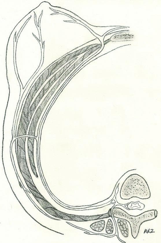 This anatomical diagram is a cross-sectional illustration of the human thorax and breast, specifically depicting the sensory innervation of the nipple-areola complex (NAC). The illustration shows a thoracic vertebra and spinal cord in the lower right, representing the origin of the intercostal nerve. The nerve is traced along its anterolateral trajectory within the intercostal space, situated between the muscle layers of the chest wall. As the nerve progresses anteriorly toward the superior-left aspect of the image (the breast), it pierces the deep fascia and branches significantly into several terminal cutaneous filaments that innervate the nipple and glandular tissue. The diagram emphasizes the relationship between the axial skeleton, the intercostal musculature, and the cutaneous sensory pathways. This educational resource is designed to demonstrate the typical surgical anatomy relevant to breast augmentation, mastectomy, or reconstructive procedures, specifically focusing on the pathway of the fourth intercostal nerve.