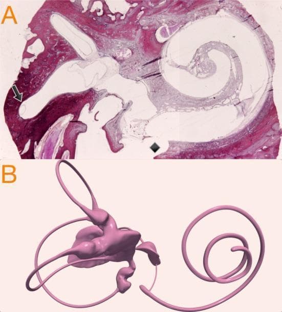 This dual-panel image displays the anatomy of the human inner ear through histological and volumetric reconstruction. (A) A Hematoxylin and Eosin (H&E) stained histological section of the temporal bone in a parasagittal plane. It clearly shows the coiled architecture of the cochlea and vestibular components. A black arrow identifies the endolymphatic horizontal duct within the osseous space, highlighting the spatial ratio between the membranous and bony canals. A black diamond indicates a post-mortem promontorial cochleostomy, demonstrating endosteal layer injury and traumatic penetration of the scala tympani. (B) A micro-CT volumetric 3D reconstruction of the endolymphatic spaces within the membranous labyrinth. The model, rendered in pink, illustrates the integrated fluid-filled anatomy including the spiral cochlea, the utricle and saccule within the vestibule, and the three semicircular canals. This figure serves as an anatomical reference for inner ear pathology, specifically regarding endolymphatic hydrops and surgical access to the cochlear base.