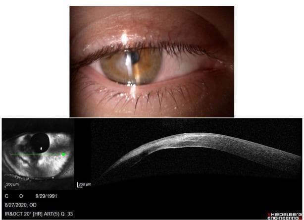 This composite educational material displays clinical imaging of the right eye, featuring a slit lamp photograph and an anterior segment optical coherence tomography (AS-OCT) scan. The slit lamp image reveals a central corneal opacity with hazy, irregular surface reflections, suggesting structural distortion and tissue remodeling. Below, the corresponding AS-OCT scan provides a cross-sectional view of the cornea, demonstrating a loss of normal stromal lamellar architecture. Key findings include a hyper-reflective area within the deep stroma, consistent with dense scarring following the regression of corneal hydrops. The corneal profile shows significant irregularity and thinning in specific regions, along with a disruption of the posterior surface (Descemet's membrane). This visual resource illustrates the clinical and anatomical progression of advanced keratoconus complications, specifically the transformation of acute hydrops into chronic stromal scarring. It serves as an example for ophthalmology students in identifying corneal pathology and interpreting diagnostic imaging modalities used to monitor disease resolution and tissue integrity.