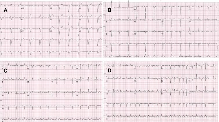 This diagnostic image displays four 12-lead electrocardiogram (ECG) tracings, labeled A through D, illustrating various cardiac conduction states in a patient undergoing His bundle pacing (HBP). Panel A shows a wide QRS complex (>150 ms) with a classic left bundle branch block (LBBB) morphology, characterized by dominant S waves in V1 and broad, notched R waves in lateral leads I and aVL. Panel B demonstrates the effect of selective HBP, showing recruitment of the bundle branches and significant QRS narrowing, effectively resolving the LBBB pattern. Panel C illustrates the return of the intrinsic LBBB conduction and widened QRS when pacing is inhibited, featuring secondary T-wave inversions. Panel D displays the results of burst atrial pacing, demonstrating 1:1 atrioventricular conduction with a narrow QRS complex and no evidence of rate-related LBBB. This comparative set is used in electrophysiology to illustrate the efficacy of HBP in correcting intraventricular conduction delays and managing pacing-induced cardiomyopathy.