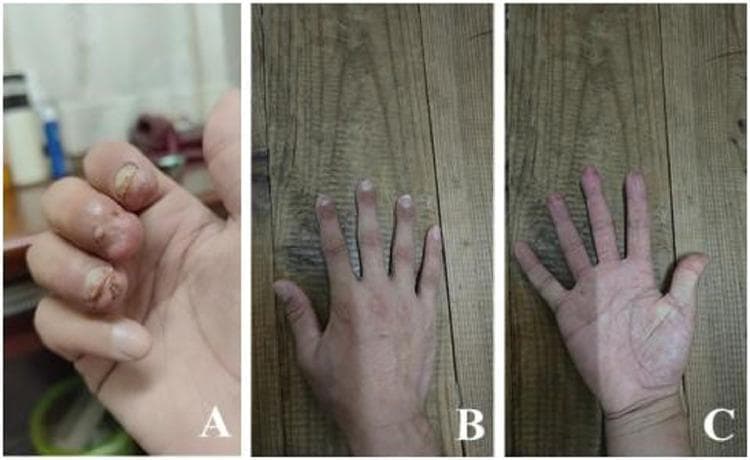 This set of clinical photographs illustrates the preoperative trauma and postoperative long-term results of a multiple fingertip replantation. Image A shows a preoperative view of the right hand featuring traumatic complete amputations of the index, middle, and ring fingertips at the level of the nail bed (Tamai Zone 1). Visible findings include irregular wound margins, severe tissue contusion, and contamination of the distal phalanx regions. Images B (dorsal view) and C (palmar view) demonstrate the patient’s right hand several months after emergency supermicrosurgery, including end-to-end anastomosis of the arcuate arteries and fracture fixation. The postoperative images reveal successful tissue survival with well-healed surgical sites, preserved finger length, and nearly normal cosmetic appearance. The skin texture and color on both the dorsal and palmar aspects of the replanted digits appear healthy and consistent with the surrounding anatomy, indicating successful revascularization and functional recovery of the digital pulp and nail units.