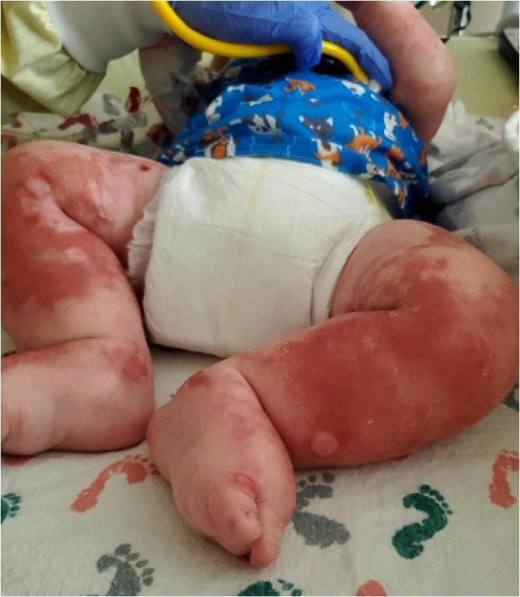 Clinical photograph of an infant's lower extremities exhibiting severe dermatological and systemic manifestations of malnutrition. The image shows diffuse, well-demarcated reddish-brown erythematous plaques with a 'flaky paint' appearance, characteristic of the dermatosis seen in Kwashiorkor. Notable features include widespread scaly plaques and desquamation, as well as several bullous lesions (fluid-filled blisters) on the lateral aspect of the lower leg and dorsal foot. Significant generalized peripheral edema (anasarca) is evident, manifesting as tense, shiny skin and swelling of the thighs, legs, and feet. The distribution is bilateral and involves the flexural surfaces. These visual findings represent the classic cutaneous signs of protein-energy malnutrition, often secondary to malabsorption syndromes such as cystic fibrosis-associated pancreatic insufficiency. The presence of these lesions in a pediatric patient is a critical clinical indicator of severe metabolic and nutritional distress.
