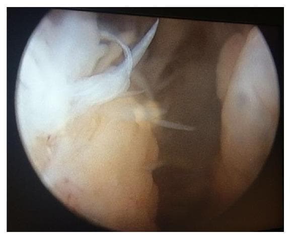 This diagnostic image shows an arthroscopic view within a joint space, specifically demonstrating significant synovial pathology. The central focus is on extensive pannus formation, characterized by a proliferation of hypertrophic synovial tissue. The pannus exhibits a variegated appearance, with areas of pale whitish-translucent fibrous strands and thicker, opaque yellowish-tan projections extending into the joint cavity. The tissue texture is notably irregular and friable, consistent with active synovial inflammation or inflammatory arthritis. In the background, deeper joint structures and synovial lining appear congested and brownish in hue. This visual evidence of synovial hypertrophy and pannus formation is a key clinical indicator of chronic inflammatory processes, such as rheumatoid arthritis or pigmented villonodular synovitis (PVNS), where such tissue can lead to articular cartilage erosion and joint degradation.