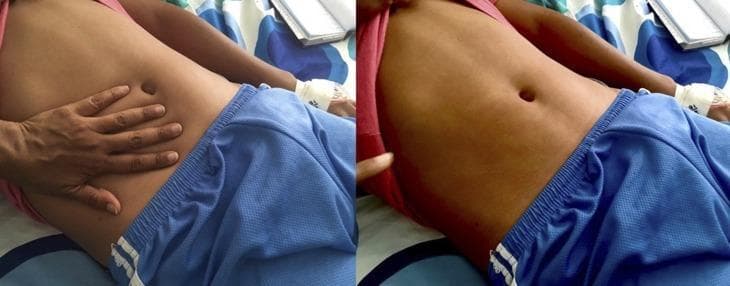 This clinical photograph displays a diffuse, erythematous maculopapular rash on the abdomen of a patient, characteristic of Dengue fever. The image is presented in a two-part sequence to demonstrate clinical blanching. On the left, a clinician's hand is shown applying direct pressure to the right side of the patient's abdomen. On the right, after the hand is removed, a clear, pale handprint-shaped outline remains where the pressure was applied, indicating that the redness fades (blanches) as blood is temporarily displaced from the superficial vessels. This finding confirms the rash is inflammatory rather than hemorrhagic (petechial/purpuric). The rash is widespread across the torso but typically spares the palms and soles in this clinical presentation. This image serves as a teaching tool for medical students and clinicians to distinguish between vascular inflammatory rashes and non-blanching hemorrhagic lesions in the context of viral hemorrhagic fevers and infectious diseases.