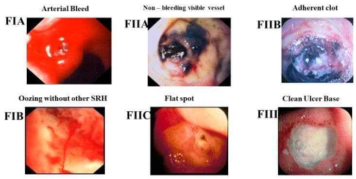 A composite clinical comparison chart displaying six endoscopic images of gastric or duodenal ulcers, classified according to the Forrest (F) criteria for stigmata of recent hemorrhage (SRH). The images illustrate the visual spectrum of peptic ulcer bleeding severity. Forrest IA (Arterial Bleed) shows active, bright red spurting blood. Forrest IB (Oozing) demonstrates a slower, continuous seepage of blood over the ulcer base. Forrest IIA (Non-bleeding visible vessel) reveals a prominent, dark, raised protuberance within the ulcer without active hemorrhage. Forrest IIB (Adherent clot) depicts a large, dark, gelatinous blood clot firmly attached to the ulcer base. Forrest IIC (Flat spot) shows a non-raised, pigmented (red or brown) speckle representing a resolving hematin. Forrest III (Clean Ulcer Base) displays a smooth, whitish, fibrin-covered ulcer bed with no evidence of vascular stigmata. This infographic serves as a diagnostic tool for gastroenterologists to assess rebleeding risk and determine the necessity for endoscopic hemostatic intervention.