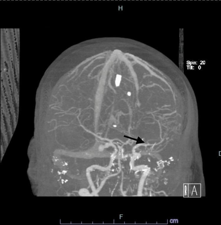 This diagnostic image is a Computed Tomography Angiography (CTA) of the brain presented as a Maximum Intensity Projection (MIP) reconstruction in a coronal-like oblique orientation. The image provides a high-contrast visualization of the intracranial vasculature against the suppressed background of neural parenchyma. The Circle of Willis and its branching vessels are clearly visible. A prominent black arrow points to a focal, hyperdense outpouching located at the origin of the left posterior communicating artery (PCOM), diagnostic of a saccular intracranial aneurysm. The vascular anatomy shows the internal carotid arteries, middle cerebral arteries, and anterior cerebral arteries, with some punctate hyperdensities likely representing calcifications or artifact at the skull base. This imaging modality is used to evaluate cerebrovascular pathology such as aneurysms, stenosis, or subarachnoid hemorrhage, providing essential anatomical mapping for neurosurgical or endovascular intervention planning.