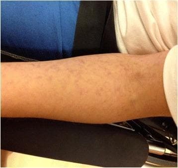 Clinical photograph of a human upper extremity demonstrating livedo reticularis. The image shows the forearm area with a characteristic reddish-blue to purplish, net-like (reticular) vascular pattern. This mottled appearance consists of irregular, interconnected rings or blotches of cyanotic discoloration surrounding central areas of normal-toned skin. The lesions appear flat and non-blanching in this view, consistent with dermal vascular congestion or vasospasm. This cutaneous finding is often associated with systemic conditions such as vasculitis, connective tissue diseases, or Susac syndrome, where it may present alongside neurological and ophthalmological symptoms. The photograph serves as an educational example of dermatological manifestations of microvascular disease, highlighting the distinctive distribution and morphology used to distinguish livedo reticularis from other forms of purpura or exanthema.