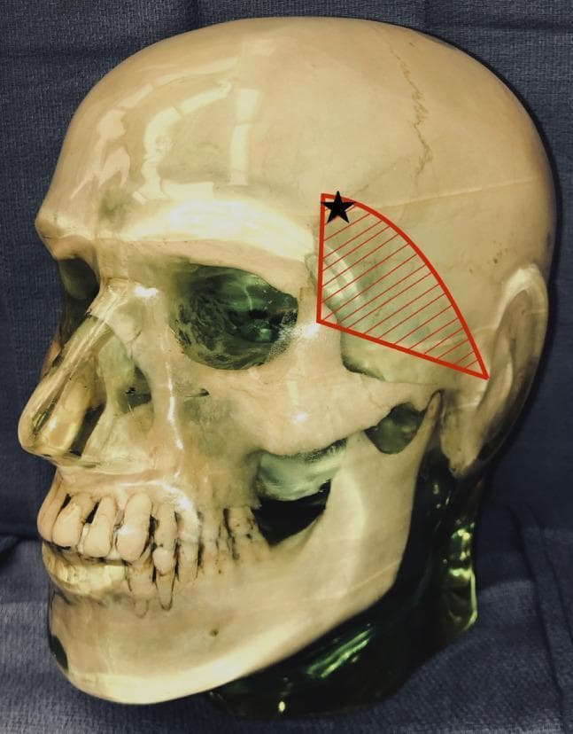 This anatomical diagram utilizes a lateral view of a human skull model to illustrate the surgical vulnerability of the temporal branch of the facial nerve. A red hatched triangular region is overlaid on the temporal fossa, bounded by the zygomatic arch inferiorly, the zygomatic process of the frontal bone anteriorly, and extending toward the superior temporal line. This area represents the danger zone where the temporal branch of the facial nerve is most superficial. A black star is marked within the superior-anterior portion of this shaded region, indicating the specific placement of a Mayfield head clamp pin that resulted in postoperative frontalis muscle palsy. The image serves as a clinical education tool for neurosurgical and orthopedic surgical positioning, highlighting the risk of iatrogenic nerve injury from external fixation devices when applied near the course of the facial nerve branches.