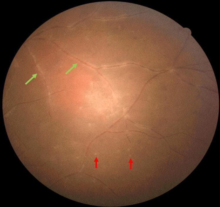 This clinical photograph displays a fundus examination of the peripheral retina, illustrating diagnostic signs of posterior uveitis, specifically associated with ocular toxoplasmosis. The image captures two primary pathological features: retinal vasculitis and punctate choroiditis. Retinal vasculitis is highlighted by green arrows, showing evidence of perivascular inflammation and vascular sheathing where the retinal vessels appear thickened and slightly obscured by inflammatory exudate. Multiple punctate choroiditis lesions are indicated by red arrows; these appear as small, discrete, yellowish-white, round-to-oval spots scattered predominantly across the inferior retinal periphery. The lesions are localized deep within the retina at the level of the choroid, representing focal inflammatory foci. This visual evidence supports the educational objective of identifying peripheral manifestations of panuveitis, including the secondary vascular and choroidal responses that occur alongside primary retinitis. These findings are critical for differentiating infectious etiologies like toxoplasmosis from systemic autoimmune conditions.